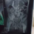 Mbarara Surgeons Remove 50 Needles from 9-Year-Old Boy’s Stomach